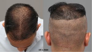 Cấy tóc FUE 3770 nang tóc, kết quả sau 11 tháng - case 101