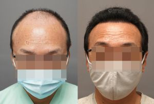 Cấy tóc FUE 3200 nang, kết quả sau 12 tháng - case 105