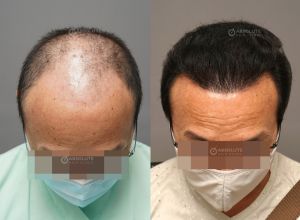 Cấy tóc FUE 3200 nang, kết quả sau 12 tháng - case 105