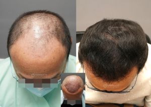 Cấy tóc FUE 3200 nang, kết quả sau 12 tháng - case 105