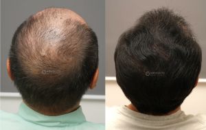 Cấy tóc FUE 3200 nang, kết quả sau 12 tháng - case 105