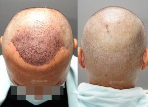 Cấy tóc FUE 3200 nang, kết quả sau 12 tháng - case 105