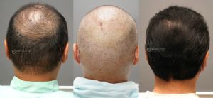 Cấy tóc FUE 3200 nang, kết quả sau 12 tháng - case 105