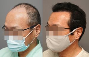 Cấy tóc FUE 3200 nang, kết quả sau 12 tháng - case 105