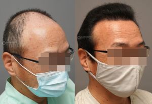 Cấy tóc FUE 3200 nang, kết quả sau 12 tháng - case 105