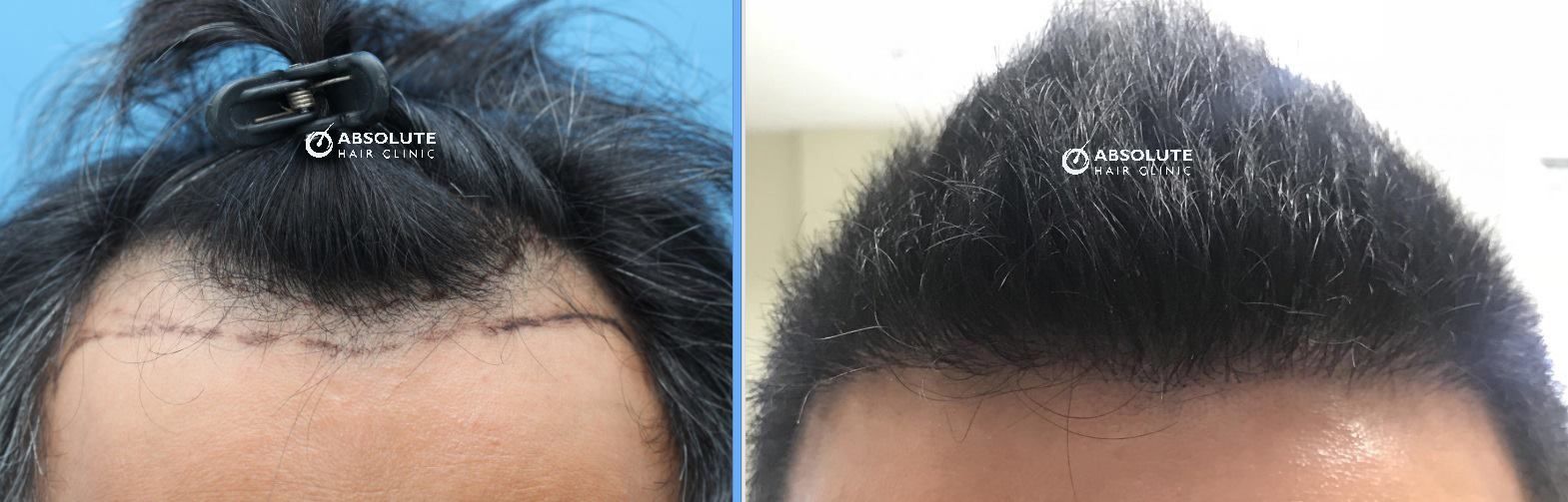Cấy tóc FUE 2629 nang, kết quả sau 7 tháng - case 11