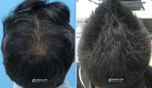 Cấy tóc FUE 2629 nang, kết quả sau 7 tháng - case 11