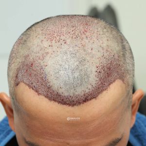 Cấy tóc FUE 2629 nang, kết quả sau 7 tháng - case 11