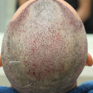 Cấy tóc FUE 2629 nang, kết quả sau 7 tháng - case 11