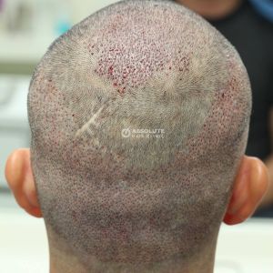 Cấy tóc FUE 2629 nang, kết quả sau 7 tháng - case 11