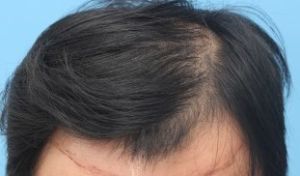 Cấy tóc FUE 3500 nang trong 2 ngày, kết quả sau 1 năm - case 14