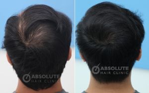 Cấy tóc FUE 3500 nang trong 2 ngày, kết quả sau 1 năm - case 14