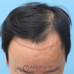 Cấy tóc FUE 3500 nang trong 2 ngày, kết quả sau 1 năm - case 14