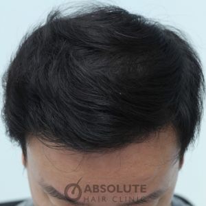 Cấy tóc FUE 3500 nang trong 2 ngày, kết quả sau 1 năm - case 14