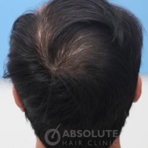 Cấy tóc FUE 3500 nang trong 2 ngày, kết quả sau 1 năm - case 14