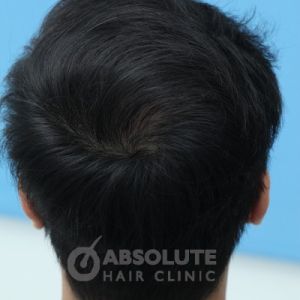 Cấy tóc FUE 3500 nang trong 2 ngày, kết quả sau 1 năm - case 14