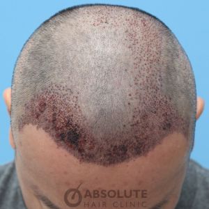 Cấy tóc FUE 3500 nang trong 2 ngày, kết quả sau 1 năm - case 14