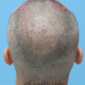 Cấy tóc FUE 3500 nang trong 2 ngày, kết quả sau 1 năm - case 14