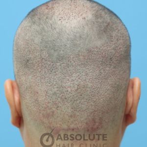 Cấy tóc FUE 3500 nang trong 2 ngày, kết quả sau 1 năm - case 14