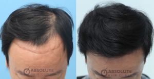 Cấy tóc FUE 3500 nang trong 2 ngày, kết quả sau 1 năm - case 14