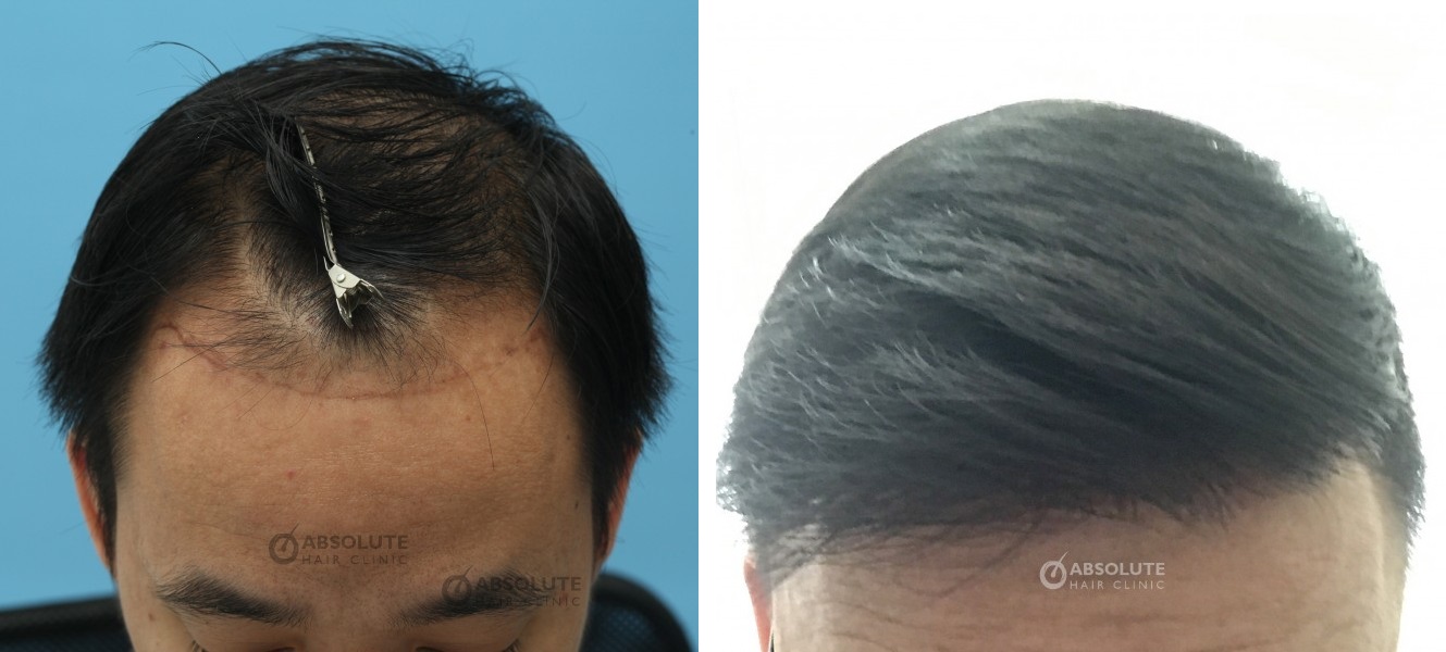 Cấy tóc FUE 2000 nang, kết quả sau 1 năm - case 16
