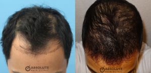 Cấy tóc 2002 nang, kỹ thuật FUE sau 7 tháng - case 22