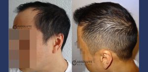 Cấy tóc 2002 nang, kỹ thuật FUE sau 7 tháng - case 22