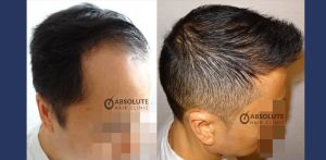 Cấy tóc 2002 nang, kỹ thuật FUE sau 7 tháng - case 22