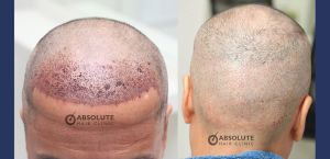 Cấy tóc 2002 nang, kỹ thuật FUE sau 7 tháng - case 22