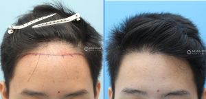 Cấy tóc FUE 1120 nang hạ thấp đường chân tóc - case 25