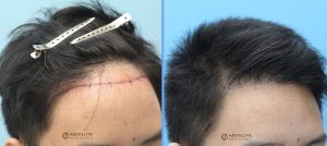 Cấy tóc FUE 1120 nang hạ thấp đường chân tóc - case 25