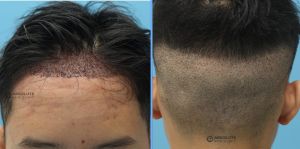 Cấy tóc FUE 1120 nang hạ thấp đường chân tóc - case 25