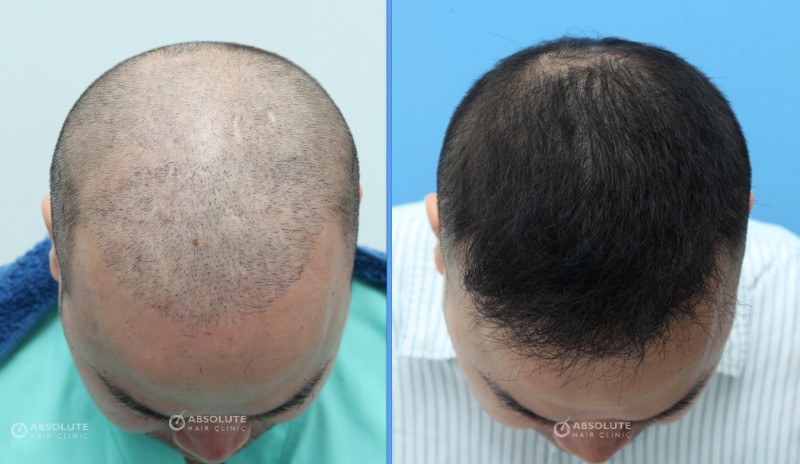 Cấy tóc FUE 2204 nang, nam 40 tuổi kết quả sau 14 tháng - case 28