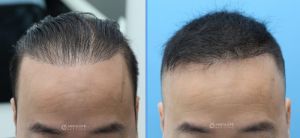 Cấy tóc FUE 2204 nang, nam 40 tuổi kết quả sau 14 tháng - case 28