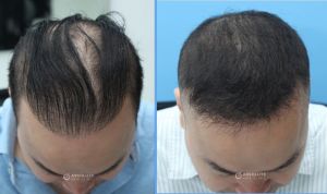 Cấy tóc FUE 2204 nang, nam 40 tuổi kết quả sau 14 tháng - case 28