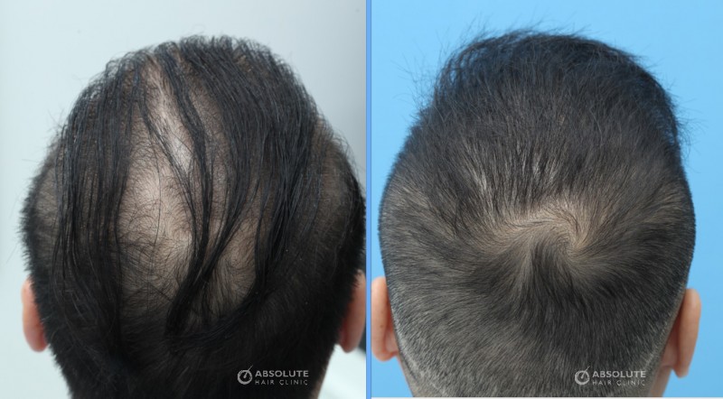 Cấy tóc FUE 2204 nang, nam 40 tuổi kết quả sau 14 tháng - case 28