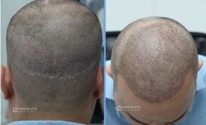 Cấy tóc FUE 2204 nang, nam 40 tuổi kết quả sau 14 tháng - case 28