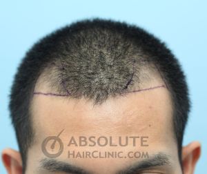 Cấy 1167 nang tóc trị hói chữ M - case 36