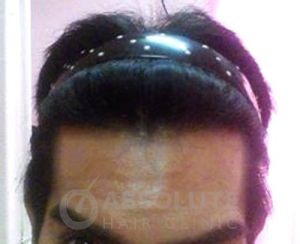 Cấy 1167 nang tóc trị hói chữ M - case 36