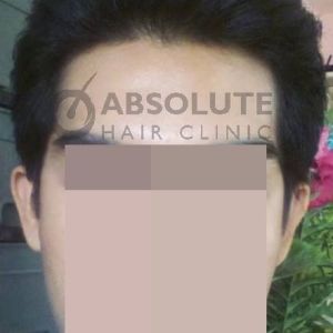 Cấy 1167 nang tóc trị hói chữ M - case 36