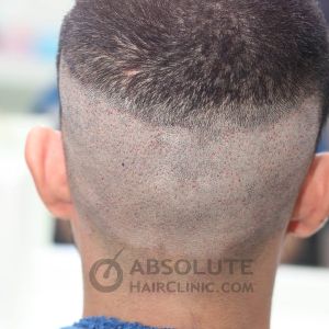 Cấy 1167 nang tóc trị hói chữ M - case 36