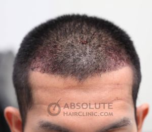 Cấy 1167 nang tóc trị hói chữ M - case 36