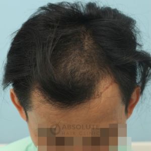 Cấy tóc FUE 2700 nang, kết quả sau 1 năm - case 37