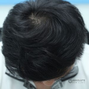 Cấy tóc FUE 2700 nang, kết quả sau 1 năm - case 37