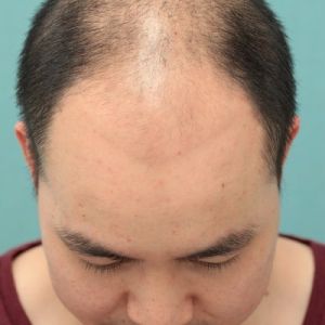 Cấy 3417 nang tóc trong 2 ngày cho giám đốc doanh nghiệp - case 39