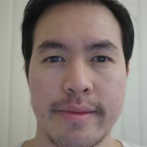 Cấy 3417 nang tóc trong 2 ngày cho giám đốc doanh nghiệp - case 39