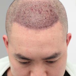 Cấy 3417 nang tóc trong 2 ngày cho giám đốc doanh nghiệp - case 39