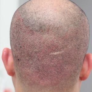 Cấy 3417 nang tóc trong 2 ngày cho giám đốc doanh nghiệp - case 39