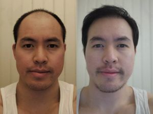 Cấy 3417 nang tóc trong 2 ngày cho giám đốc doanh nghiệp - case 39