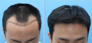 Cấy tóc FUE 1989 nang, nam 37 tuổi, kết quả sau 8 tháng - case 4